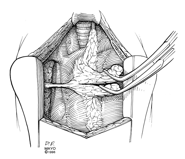 Sternal Splitting Approaches to Thymectomy for Myasthenia Gravis and