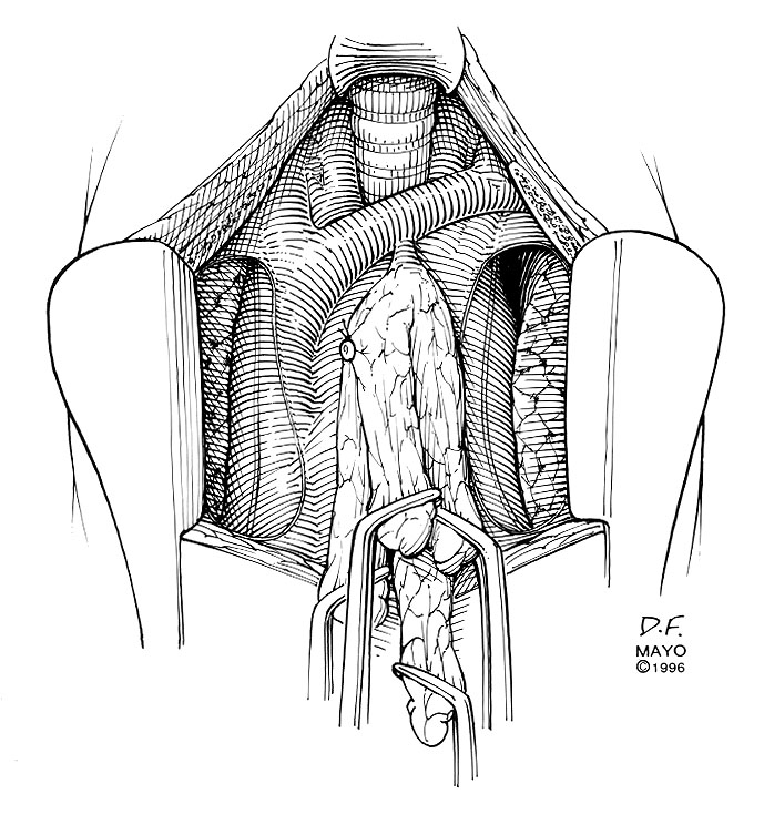 Sternal Splitting Approaches to Thymectomy for Myasthenia Gravis and